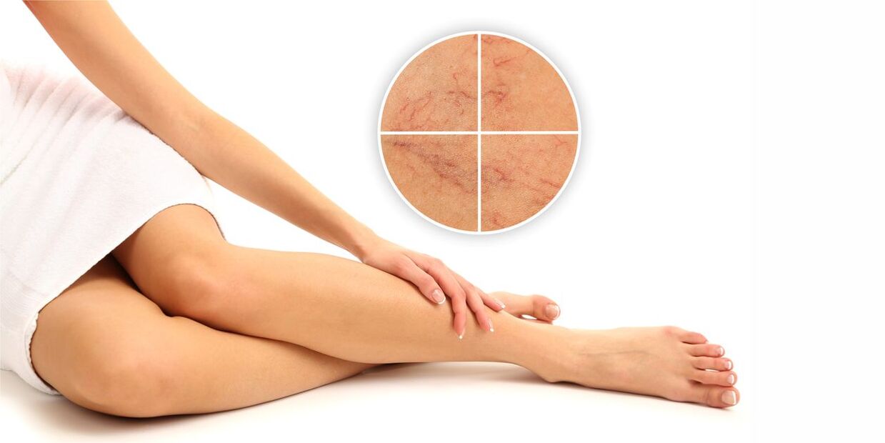 what is varicose veins in the legs